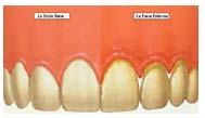 Encia sana y enferma