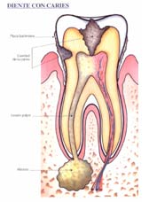 Diente con caries e infeccion apical