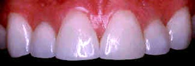 asimetría y diastema interincisivo una vez realizada la estética dental la estética dental