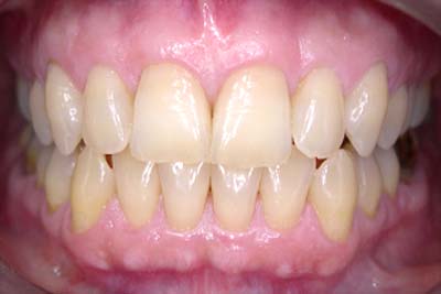 Blanqueamiento dental externo (previo al tratamiento)