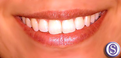 Tratamientos estéticos dentales