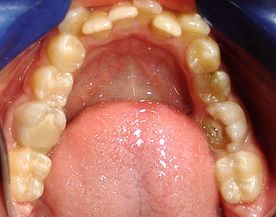 Vista oclusal del maxilar inferior