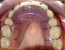 Vista oclusal del maxilar superior con la contenciÃ³n removible