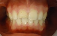 Foto inicial Pieza 1.1 con fractura Incisal