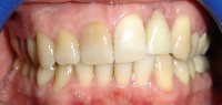 1 – Foto inicial  con piezas 1.1 y 1.2 con manchas amarillentas grisaseas en zona gingival