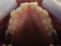 11- Vista oclusal con restauraciones estéticas