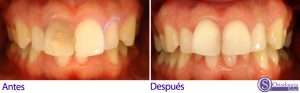 Comparativa Antes y despues del Blanqueamiento dental interno