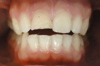 Foto de frente en leve apertura para observar la lesion