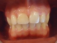 Rehabilitacion con restauracion estetica pieza 1.1