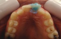 4- Vista oclusal del blanqueamiento interno pieza 1.1