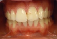 Foto inicial se observa borde incisal irregular en pieza 1.2 con peridda de esmalte en zona vetubular