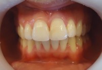 Rehabilitacion con restauracion estetica pieza 1.2 vestibulo-incisal