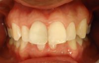 7-Cuarta sesion de blanqueo interno