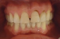 Foto inicial, se observan clases V en piezas 2.1 y 2.2 presencia de diastema interincisivo