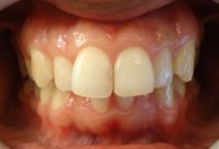 9- Finalizacion del tratamiento y restauracion estetica de ambas piezas