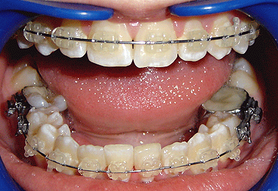 Foto de frente con aparatología en tratamiento