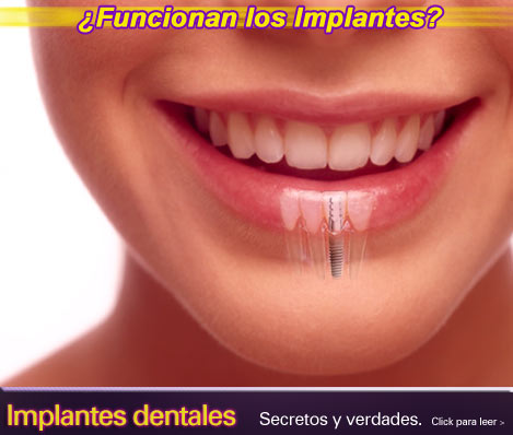 implantes dentales, implante dental, implantologo, estetica dental