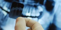 Implantes dentales, Radiografías RX