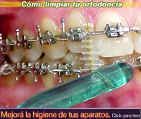 Como limpiar tus aparatos de ortodoncia