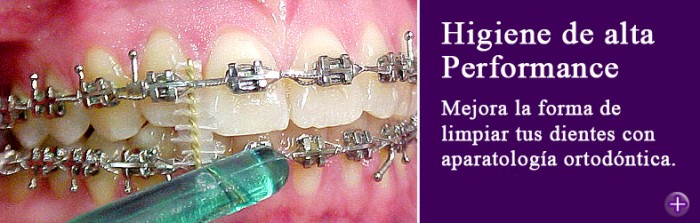 Como limpiar los dientes con ortodoncia