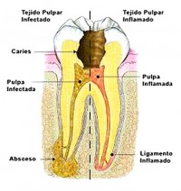 Endodoncia o tratamiento de conducto