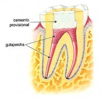 Diente a tratar con endodoncia