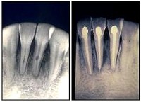 Imágenes de un tratamiento endodóntico y su posterior restauración con material estético