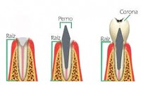 endodoncia_conducto_7