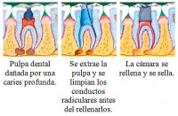 El o los dientes tratados y restaurados de este modo pueden durar toda la vida si se les cuida correctamente, ya sea que posteriormente reciba un tratamiento restaurador con pastas como composite o amalgama o bien se le realice una corona.