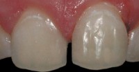 Otras veces quedan manchas en los dientes como consecuencia de un mal cepillado dentario durante el tratamiento de ortodoncia, lo que genera retención de placa bacteriana y posteriores caries alrededor de los brackets.