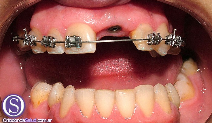 Ortodoncia e implantes
