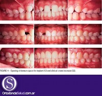 Ortodoncia e Implantes