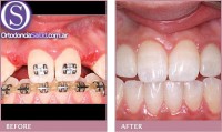 Ortodoncia e Implantes