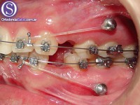 Ortodoncia e Implantess