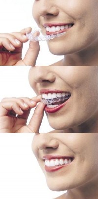 La ortodoncia invisible es una nueva técnica en el mundo de la ortodoncia a través de la cual se acomodan las piezas dentarias utilizando una serie de alineadores invisibles que permiten corregir el apiñamiento de dientes.