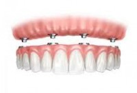 Tipos de prótesis fija