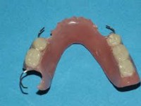 Prótesis removible completas y parciales