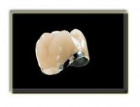 Tipos de prótesis fija