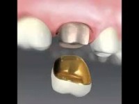 Tipos de prótesis fija