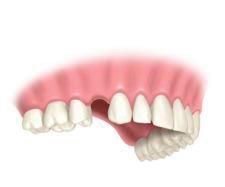 implantes_dentales_1