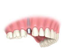 implantes_dentales_2