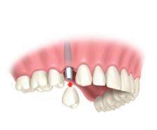 implantes_dentales_3