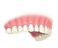 implantes_dentales_4