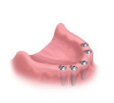 implantes_dentales_5