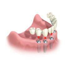 implantes_dentales_6