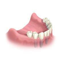 implantes_dentales_7