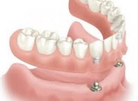 Tipos de prótesis fija