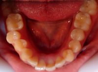5- Vista oclusal maxilar inferior apiñamiento
