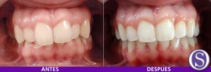 26- Comparativa antes y después del tratamiento