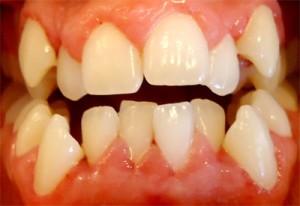 1- Foto inicial de frente en oclusion mordida abierta anterior con importante apiñamiento sup e inf, deviacion linea media dentaria
